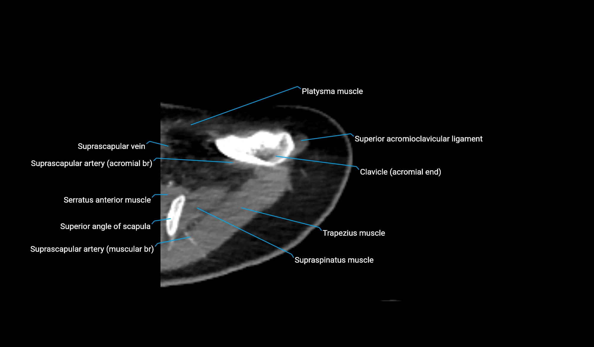 CT upper arm axial  cross sectional anatomy labelled radiology image -00056.webp